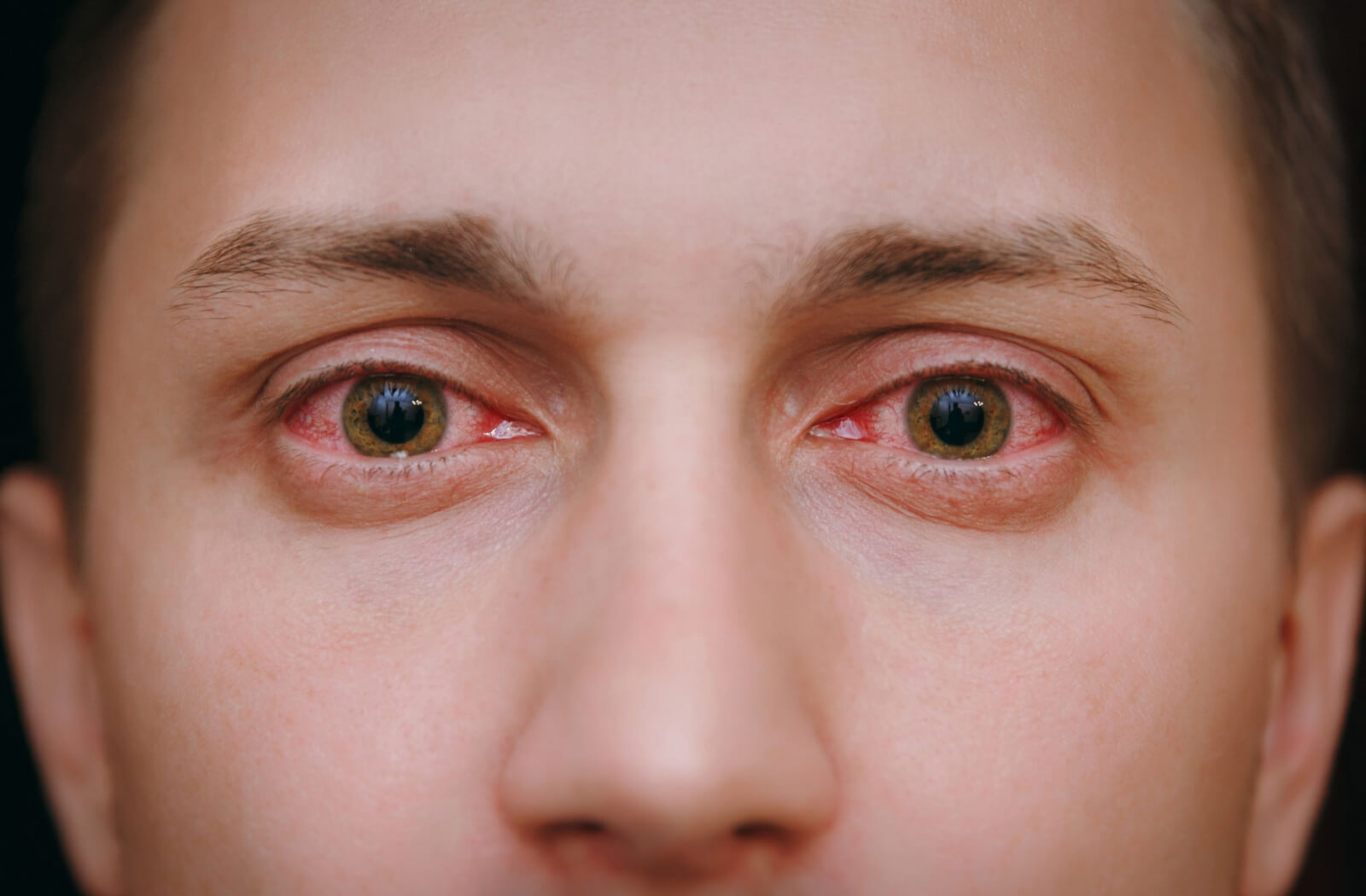 A close-up of a man's eyes got infected after sleeping with contact lenses on.