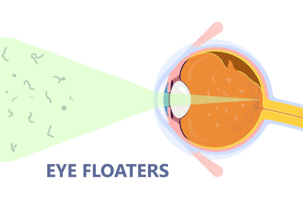 an illustrated image of a cross section of an eye, with light coming out and eye floaters depicted