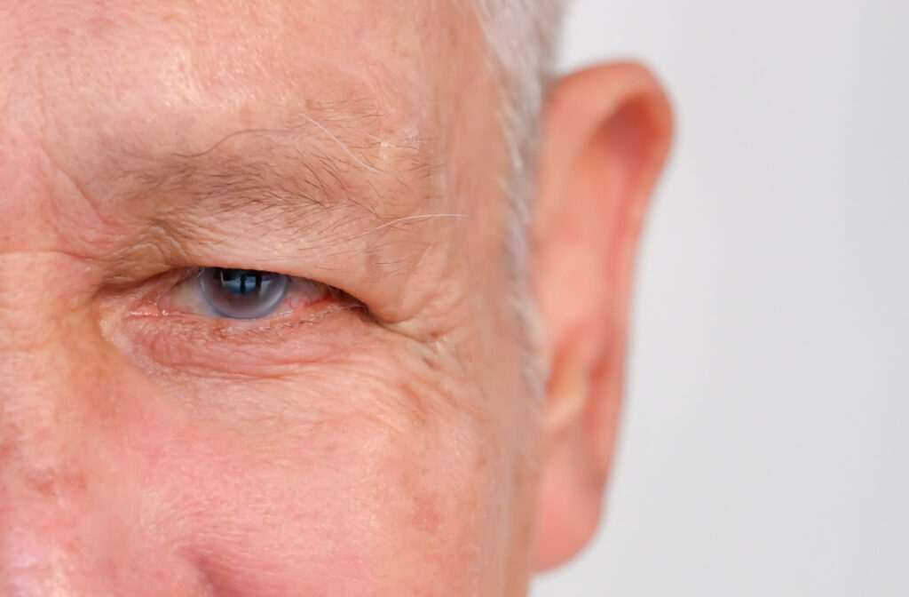 A close-up of a man presenting with glaucoma in his left eye.