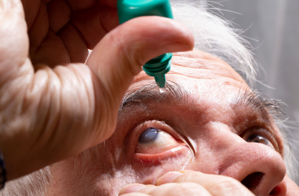 Close-up of a senior man with glaucoma putting eye drops in his right eye.