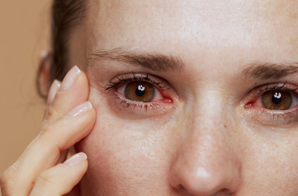 A close-up of a young person's upper face. Their eyes are red, showing dryness and irritation. The person is rubbing the side of their right eye.