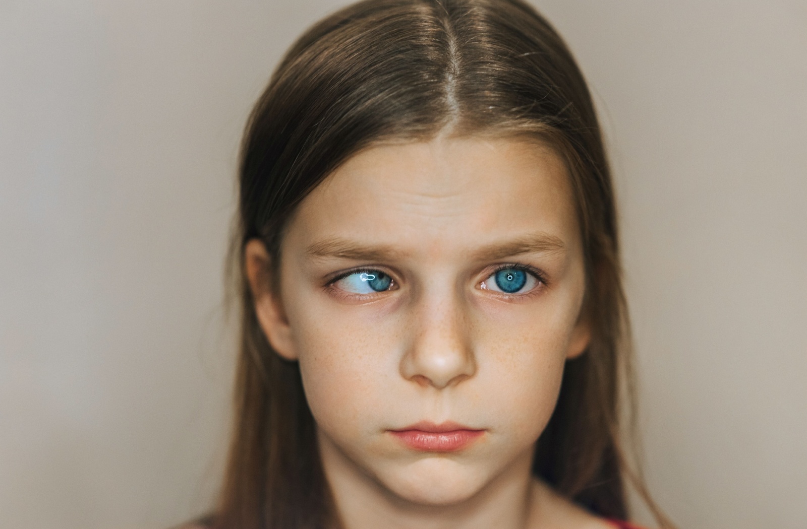 A child's right eye is misaligned, turning inwards.