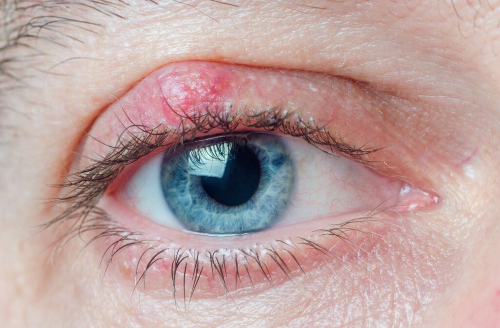 Close-up of a blue eye with a red, swollen bump on the upper eyelid consistent with a chalazion.