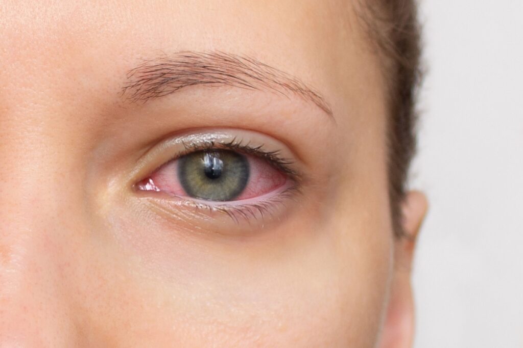 Close up eye with dry eye irritation.