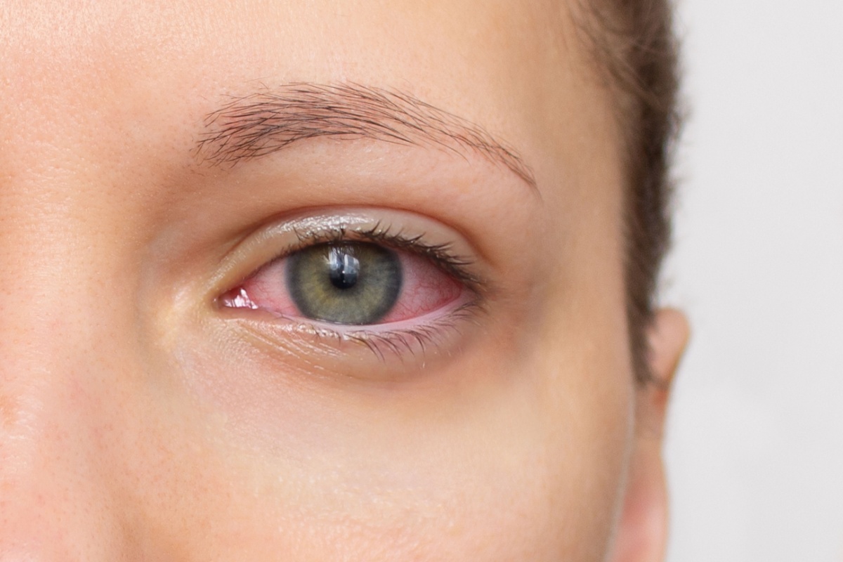 Close up eye with dry eye irritation.